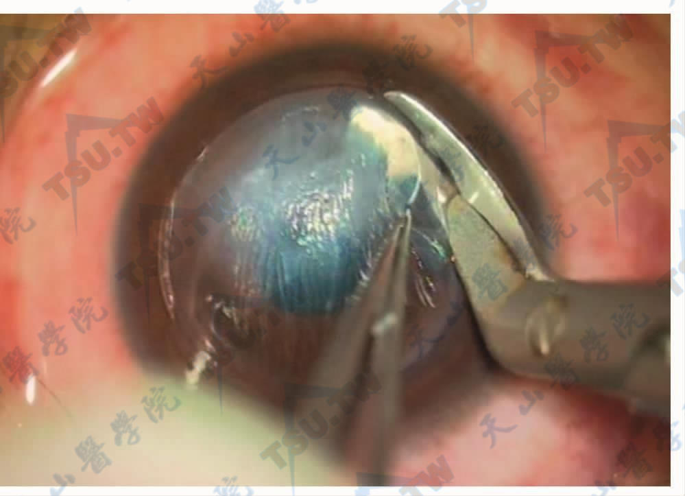 采用角膜剪沿飞秒激光切口将病变的角膜剪下