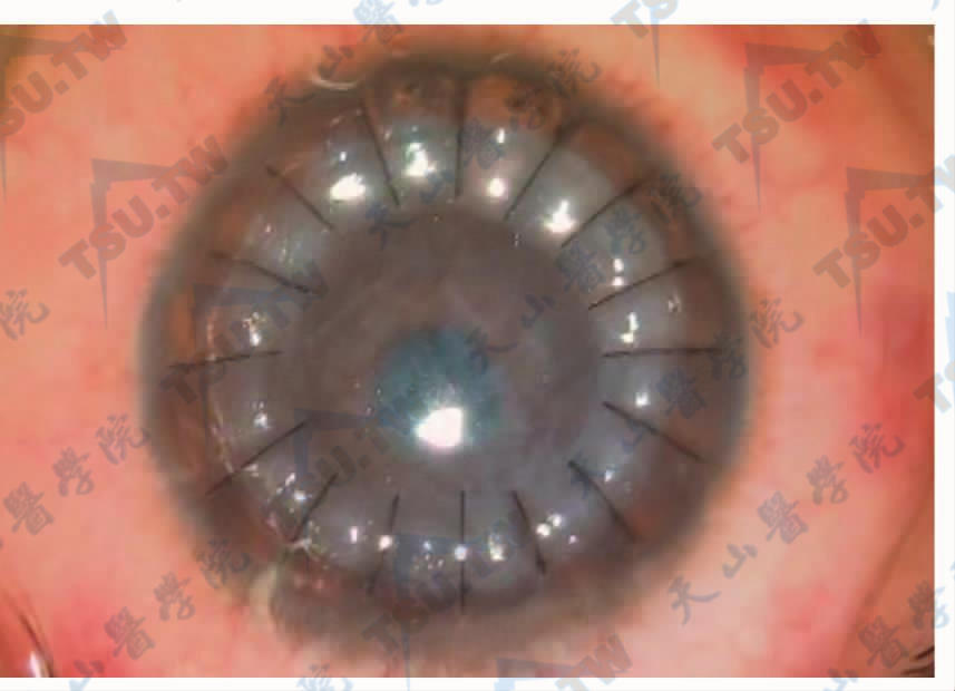10-0的尼龙线间断缝合16针后，BSS形成前房，将缝线线结旋转入植床侧的角膜层间，减少手术后的刺激症状