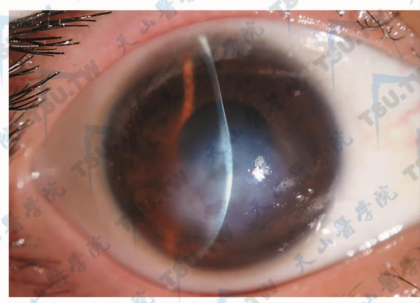 圆锥角膜急性水肿期患者，角膜明显前突。角膜中央水肿混浊