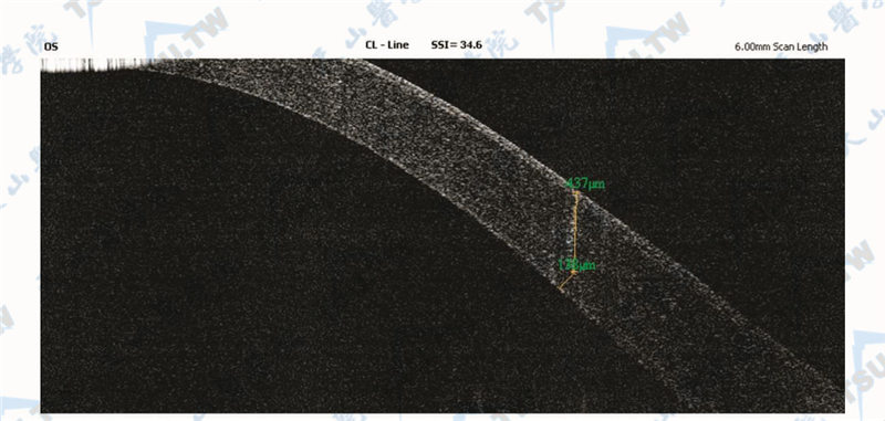 飞秒激光切削角膜后，前段OCT检查可以见到切削深度和切削角度均在理想的控制范围