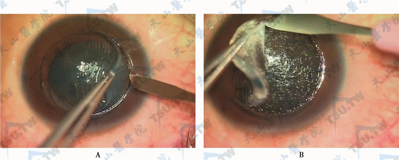 采用45°一次性角膜刀手工剥切角膜，使角膜基质床保持基本一致的厚度