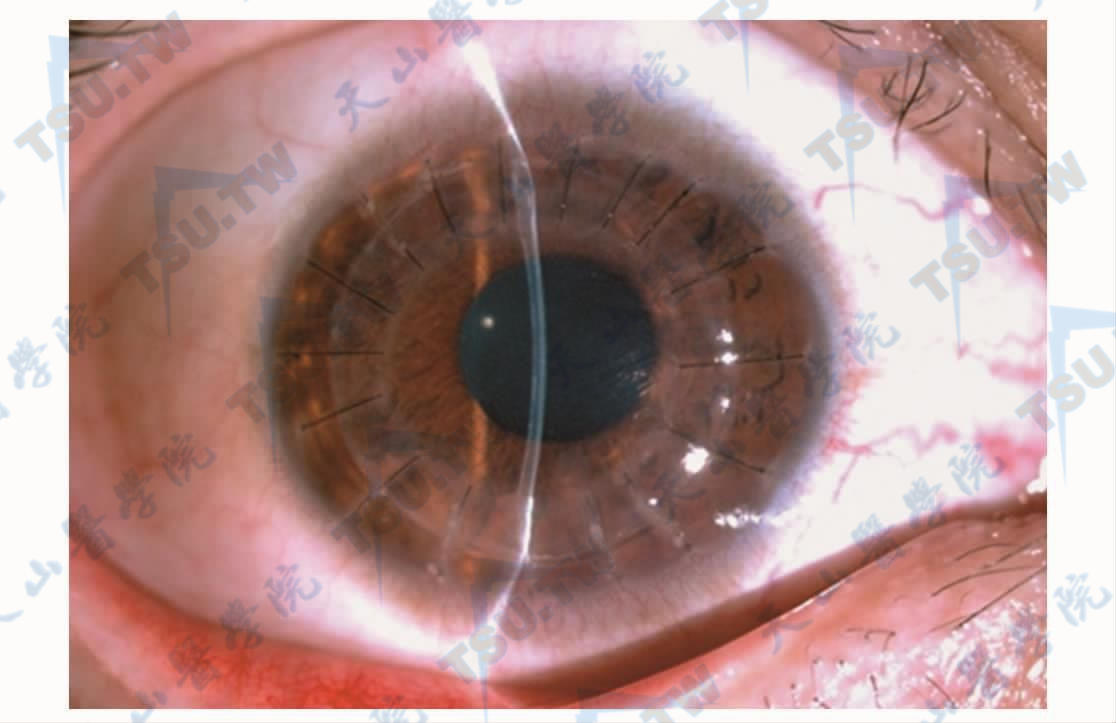 改良的飞秒激光辅助的板层眼角膜移植手术