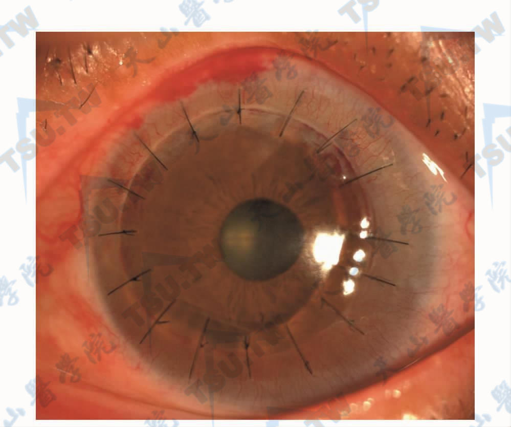 深板层角膜移植手术后第1天角膜移植片透明、边缘对合良好