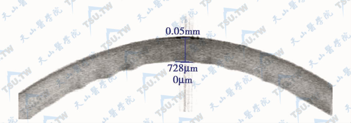 手术前OCT，角膜水肿明显，中央厚度728μm