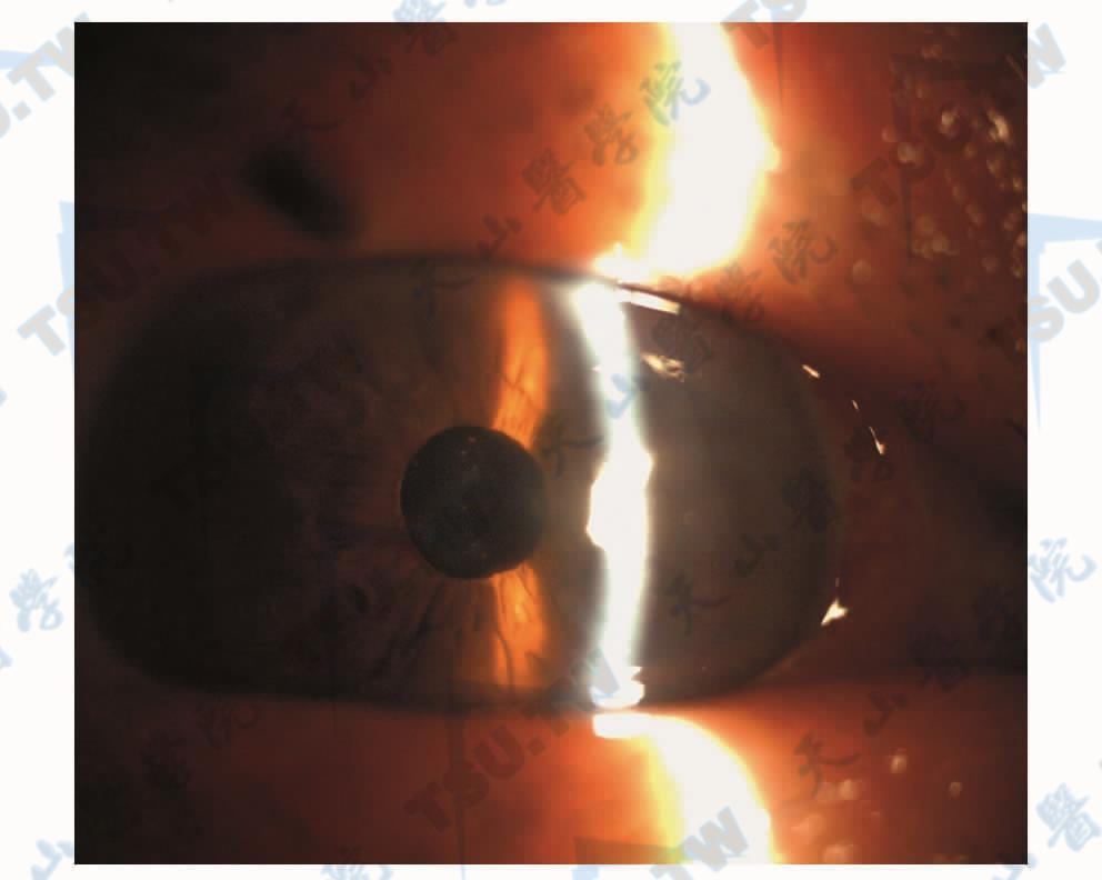 飞秒激光辅助的角膜内皮移植手术后3天，中央部角膜已经不水肿，视力0. 4