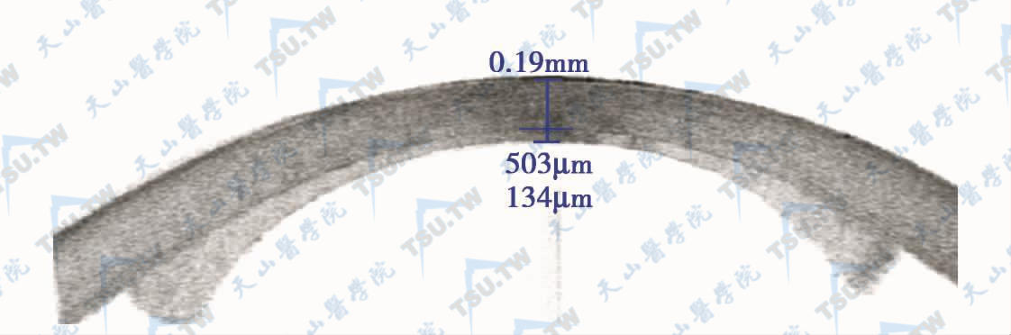 手术后3天，中央部角膜水肿明显消退，中央厚度503μm