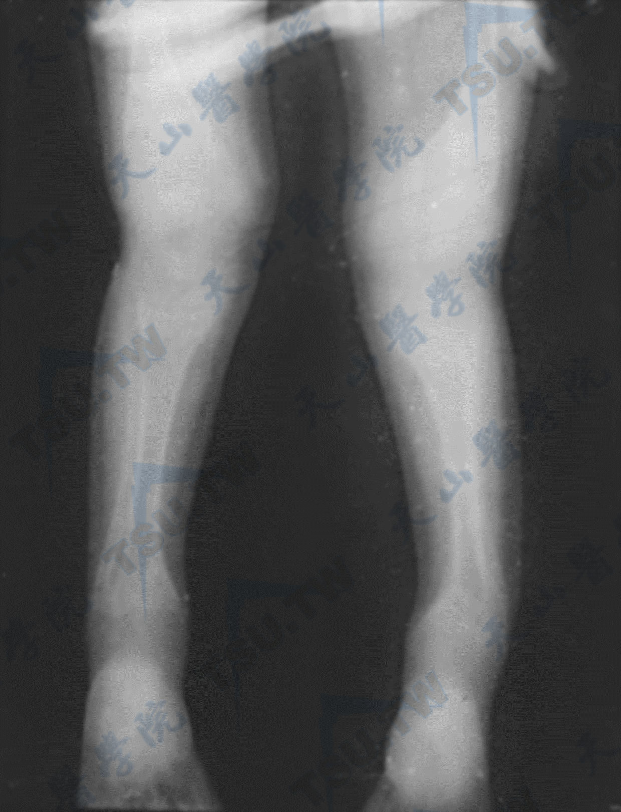 佝偻病表现为密度减低/骨小梁稀疏/骨骺骨化中心延迟/O型-X型下肢畸形