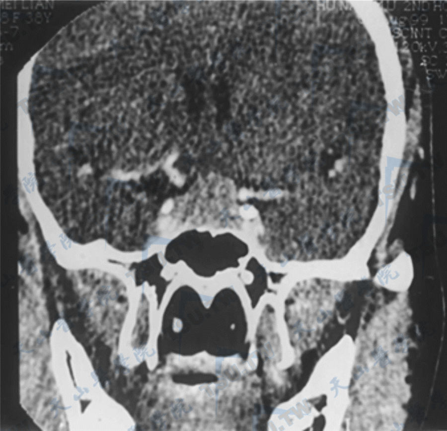 垂体大腺瘤CT检查