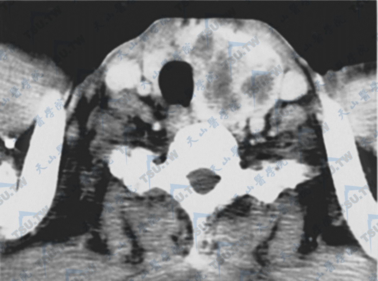 甲状腺腺癌CT显像