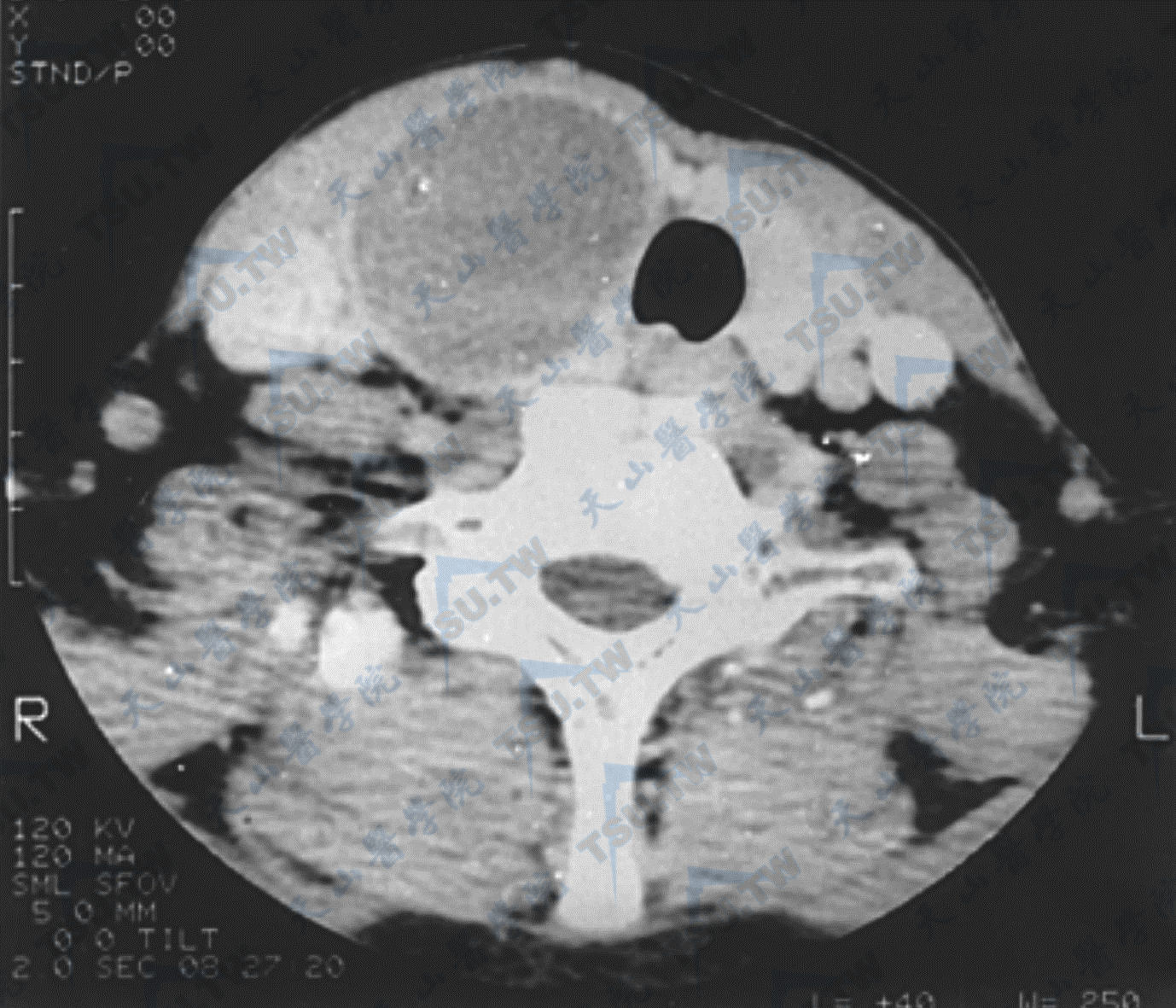 甲状腺囊肿CT显像