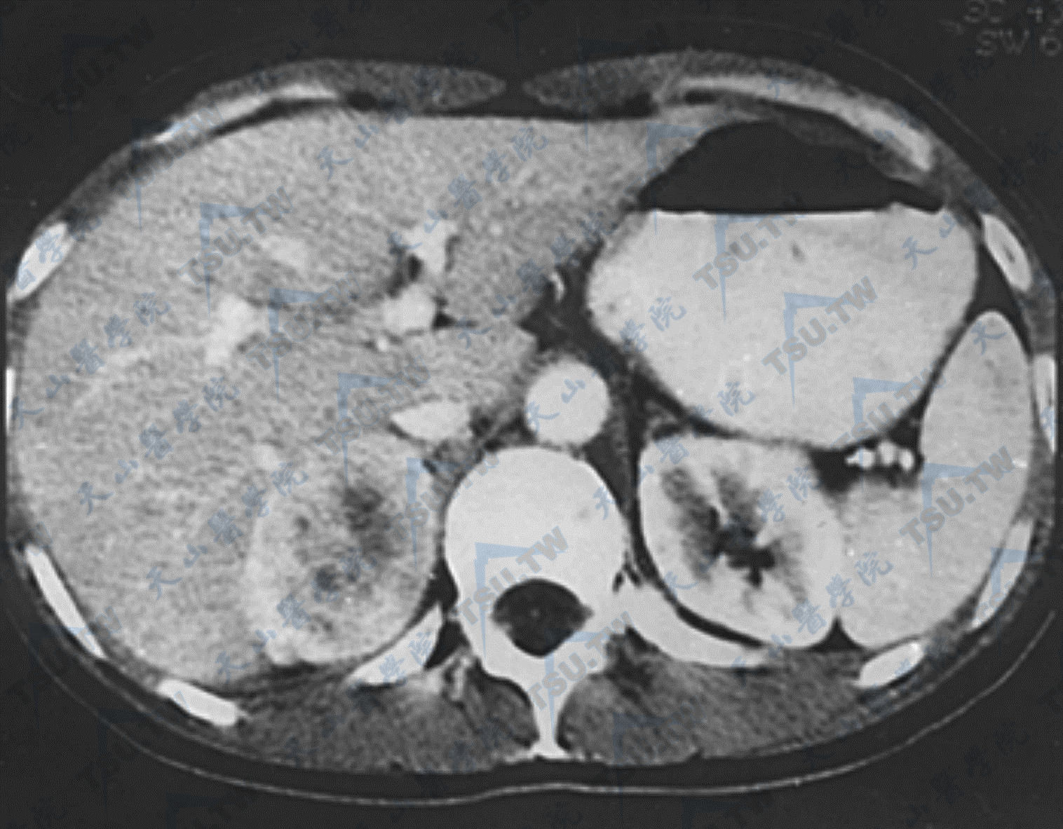 右肾上腺嗜铬细胞瘤CT显像