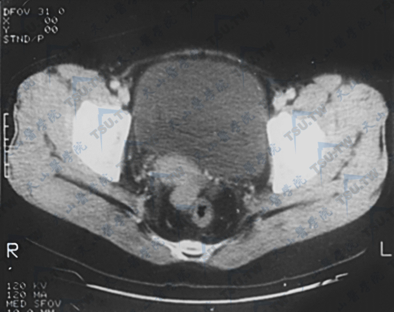 CT诊断女性盆腔疾病