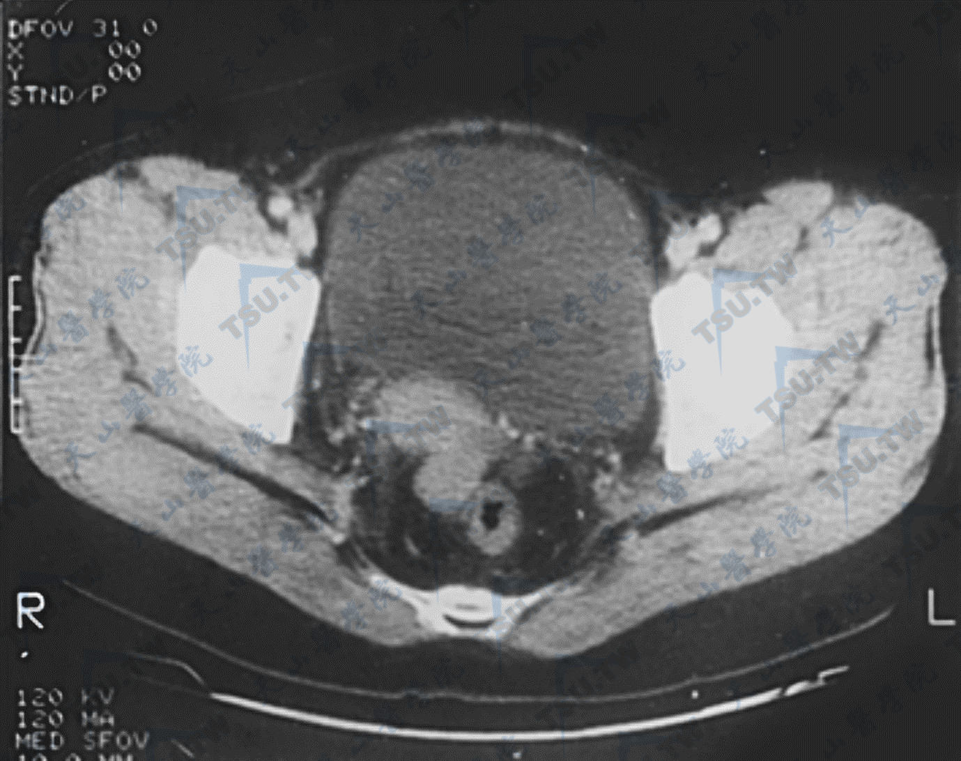 160. 前庭大腺腺样囊性癌-外科病理疑难病例鉴别诊断-医学