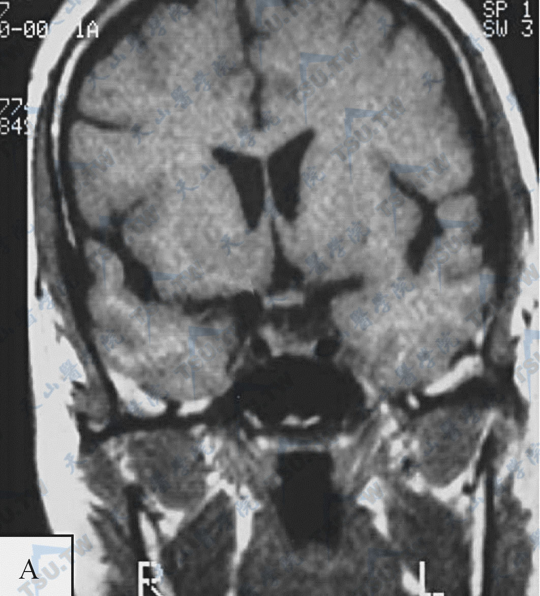 MRI和CT联合诊断垂体瘤等病变