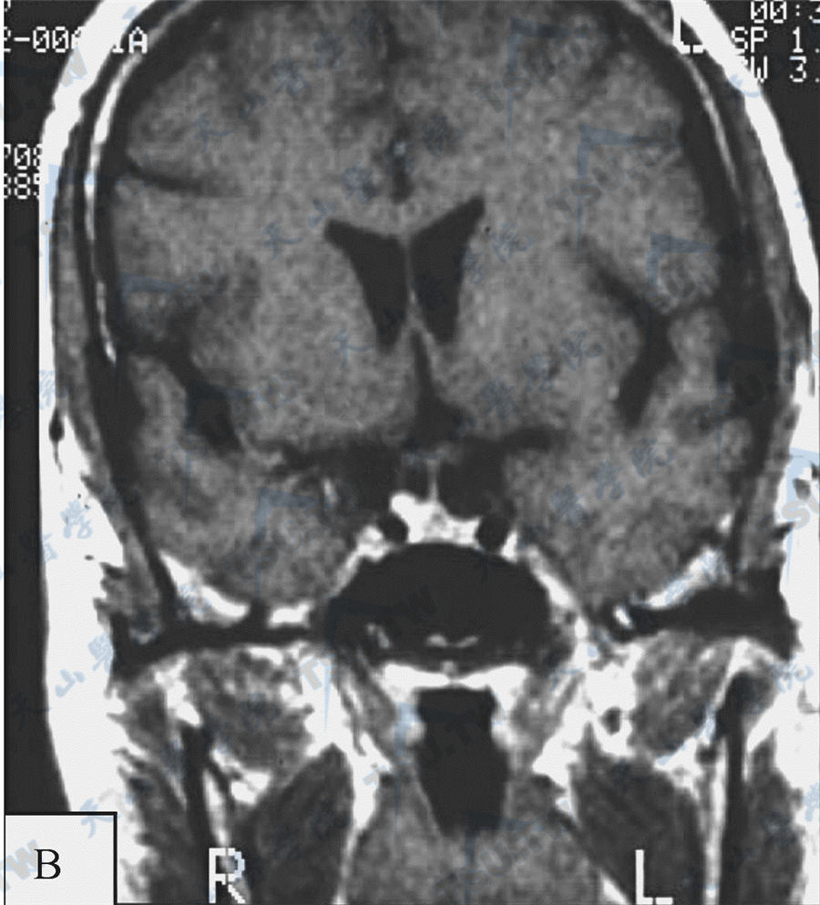 垂体大腺瘤（MRI）成像