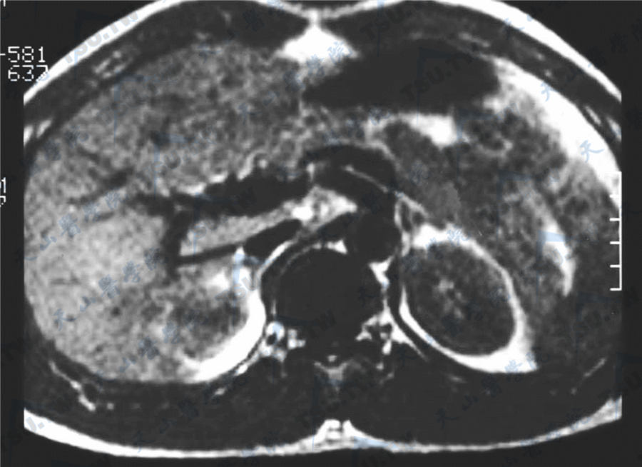 肾上腺磁共振（MRI）鉴别增生、腺瘤、结节性质
