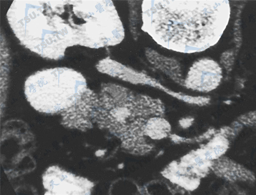 胰腺核磁共振（MRI）检查