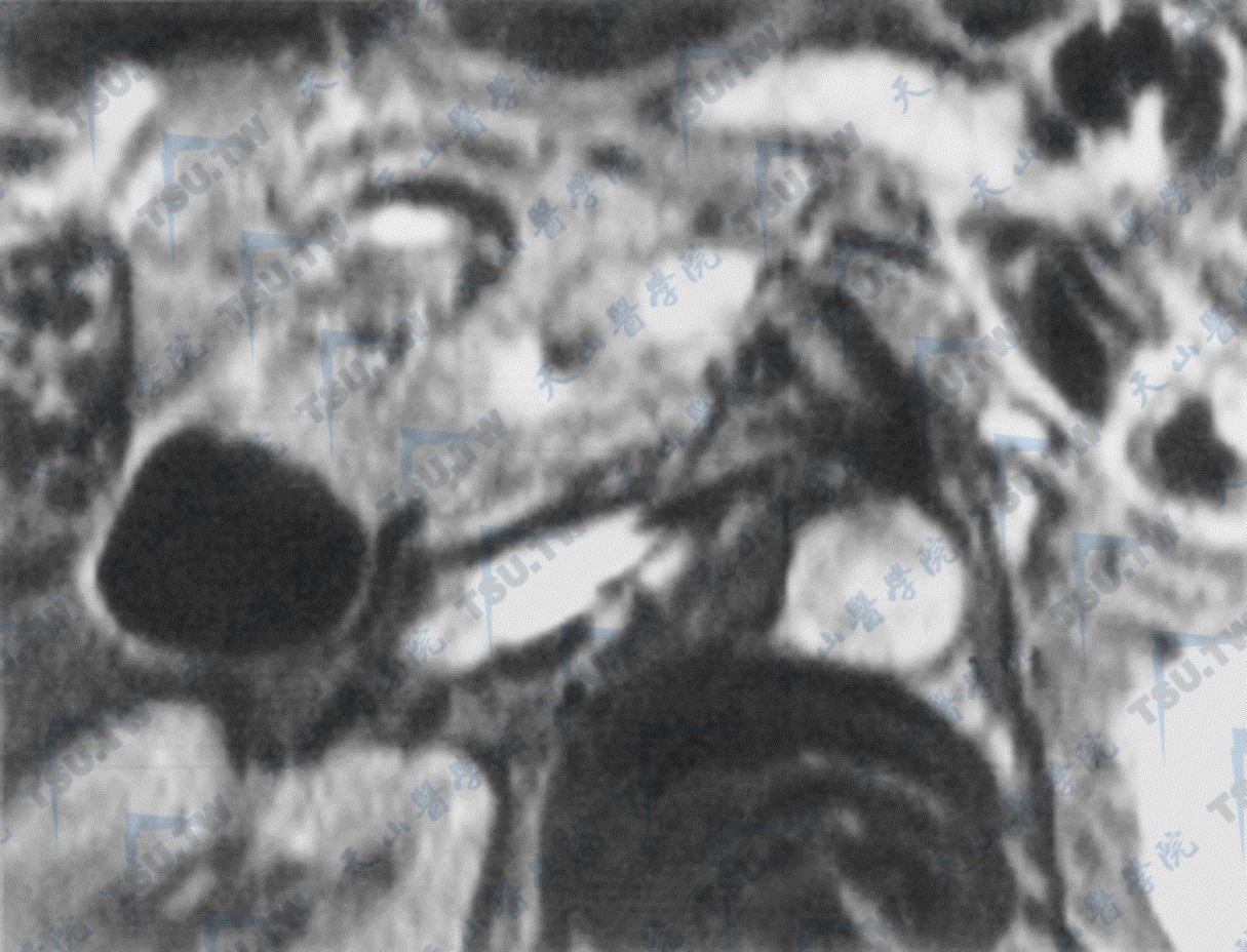 胰岛细胞癌（MRI）核磁共振成像