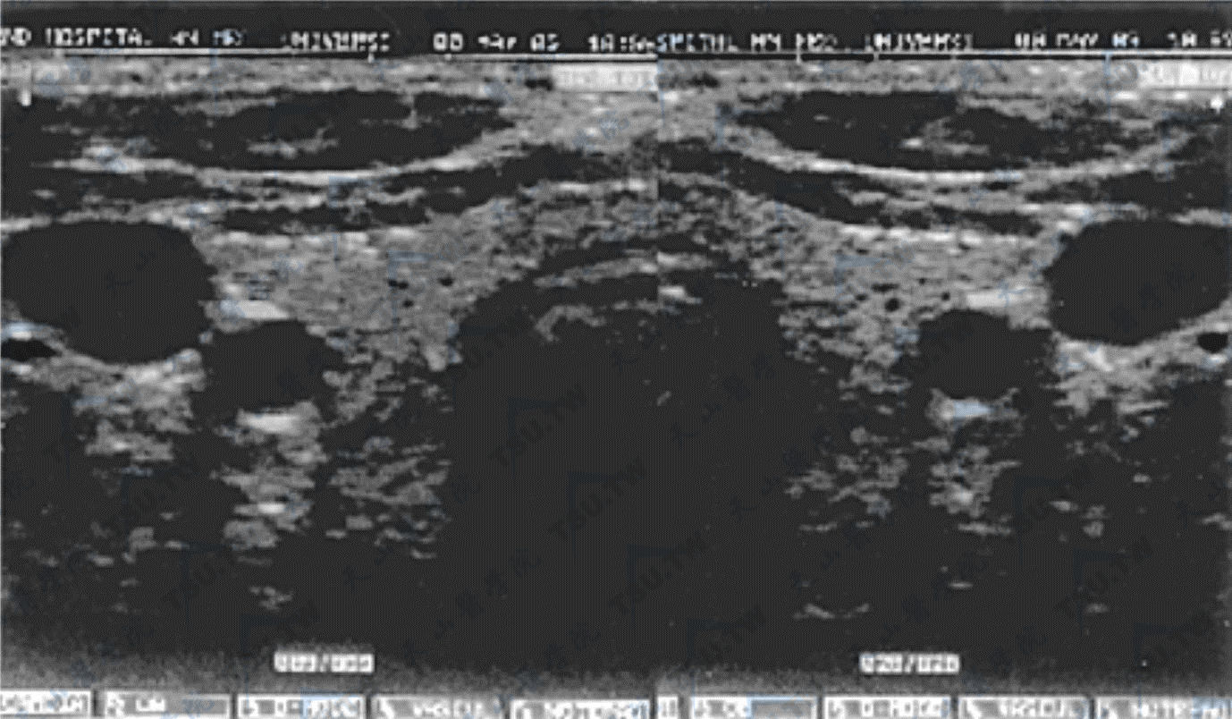 正常甲状腺超声图像