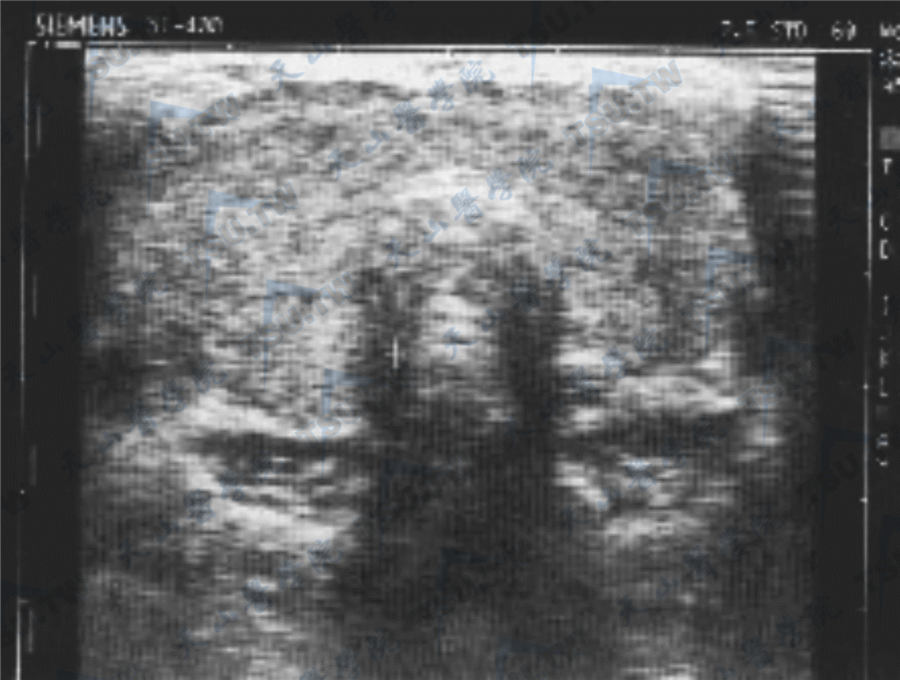 甲状腺疾病超声检查图像