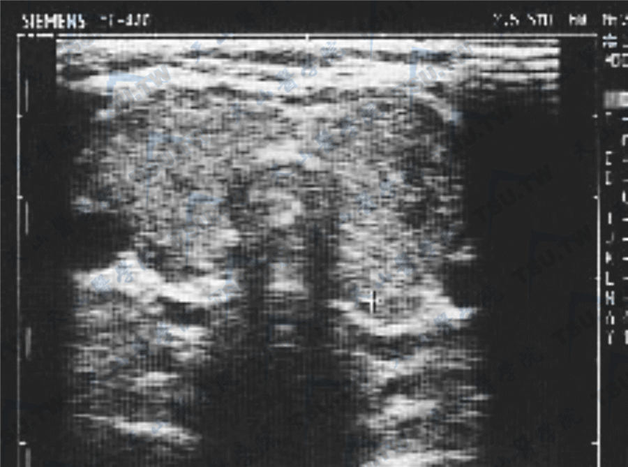 非毒性甲状腺肿超声图像