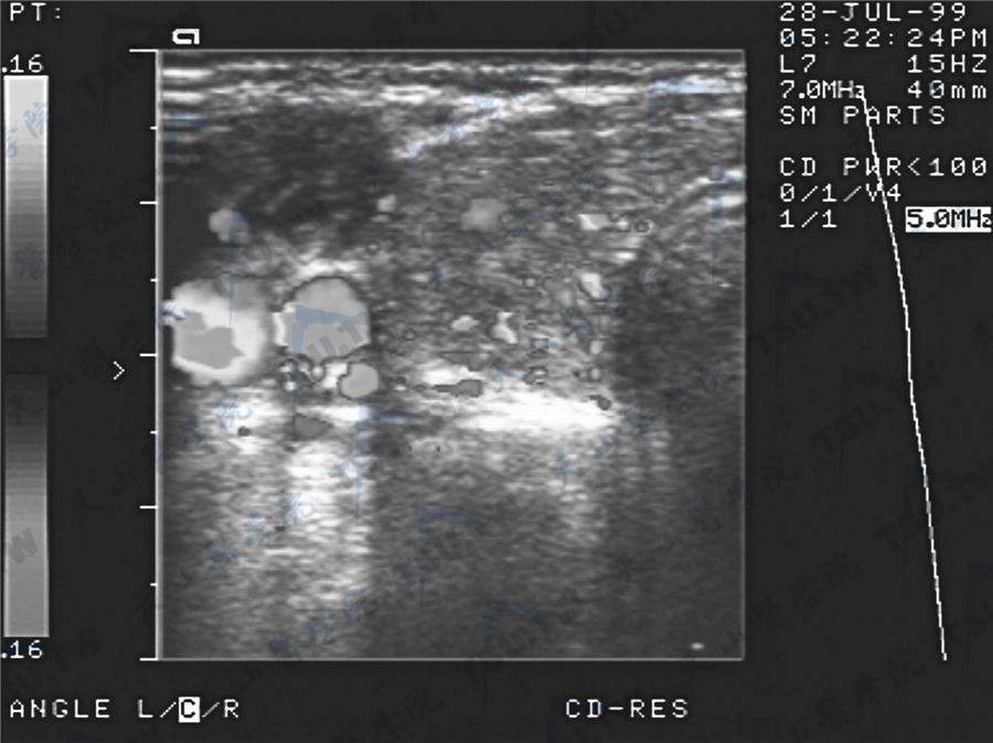 亚急性甲状腺炎超声图像