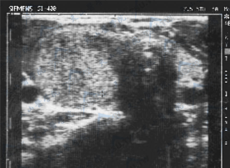甲状腺腺瘤超声图像