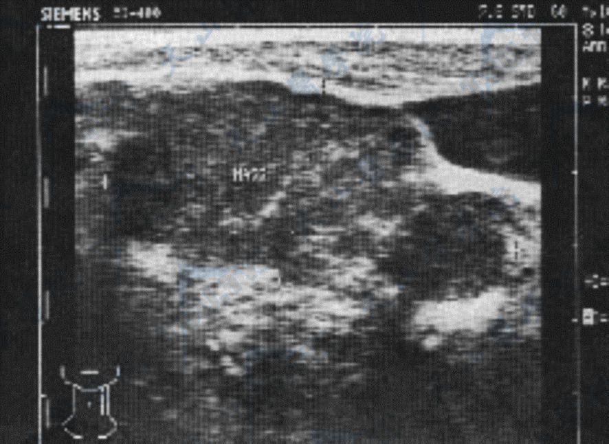甲状腺癌颈部转移超声图像