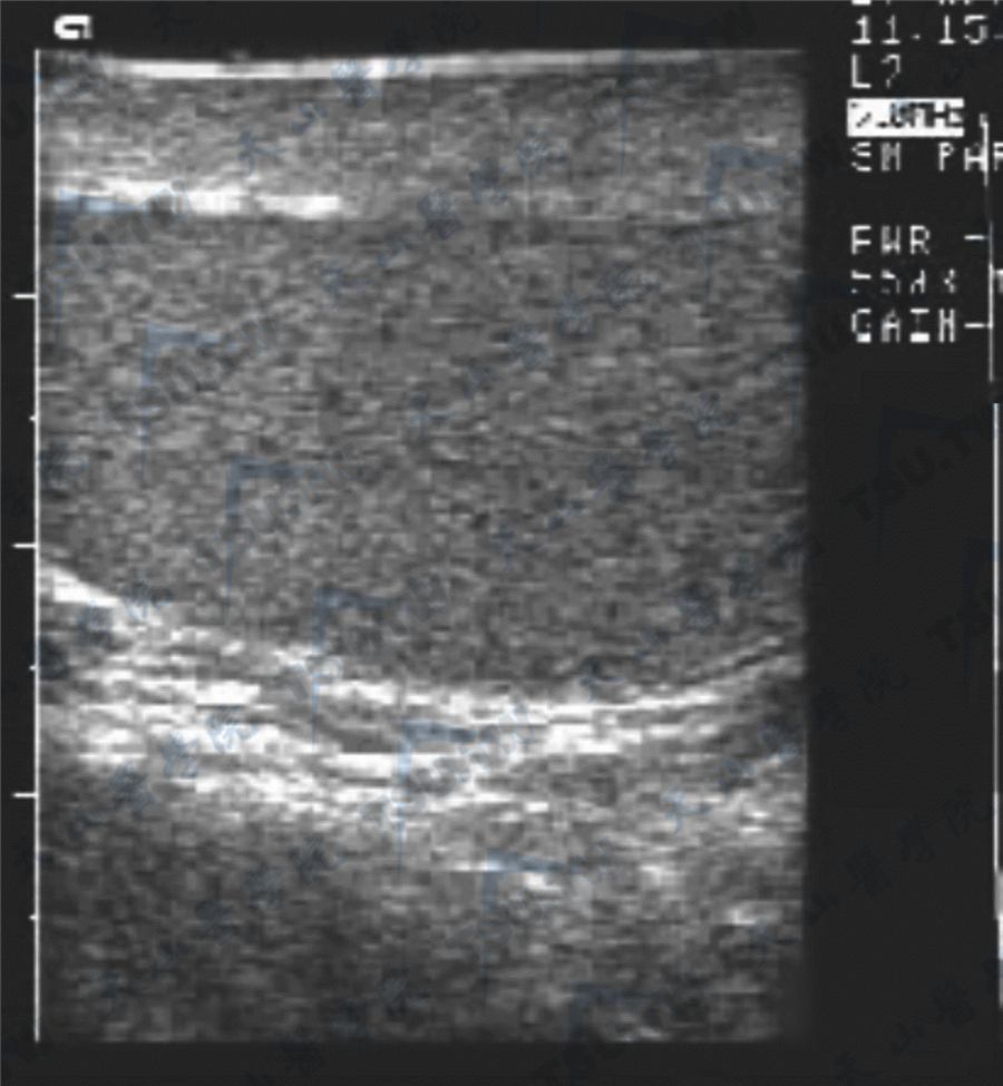 男性性腺（睾丸）超声检查方法与正常声像图