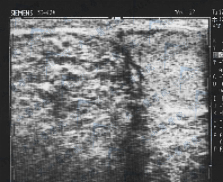 睾丸精原细胞瘤超声检查图像
