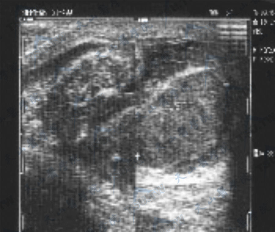 混合性睾丸肿瘤超声检查图像