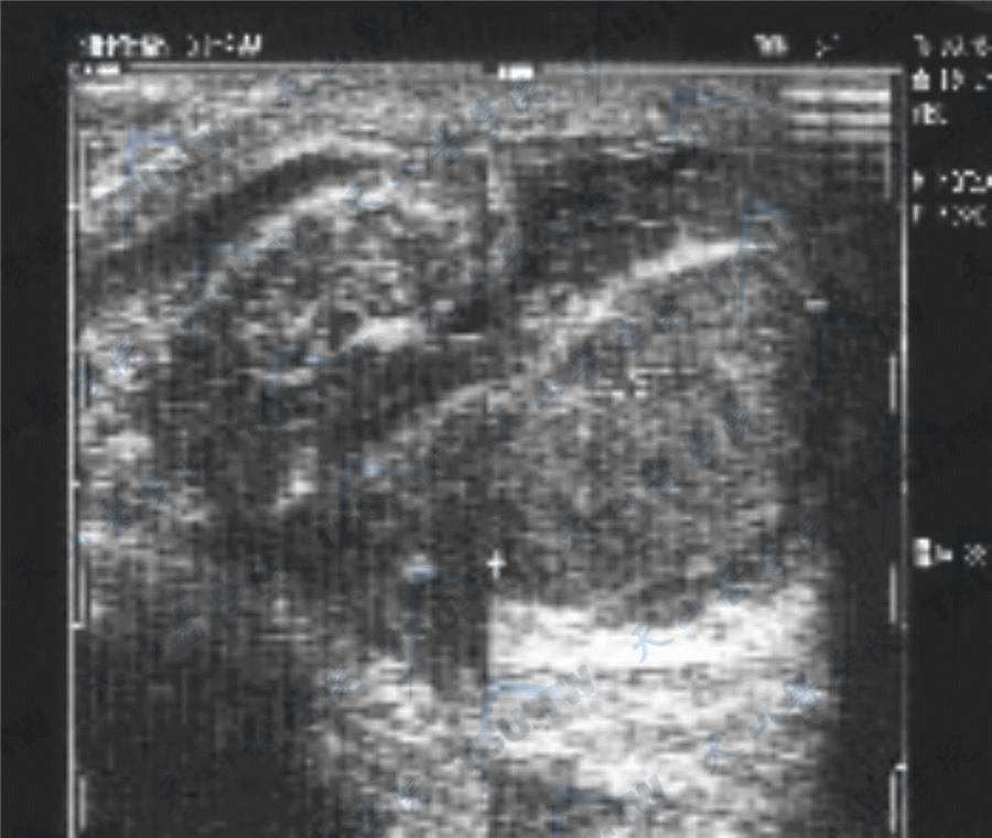 睾丸超声检查的临床应用