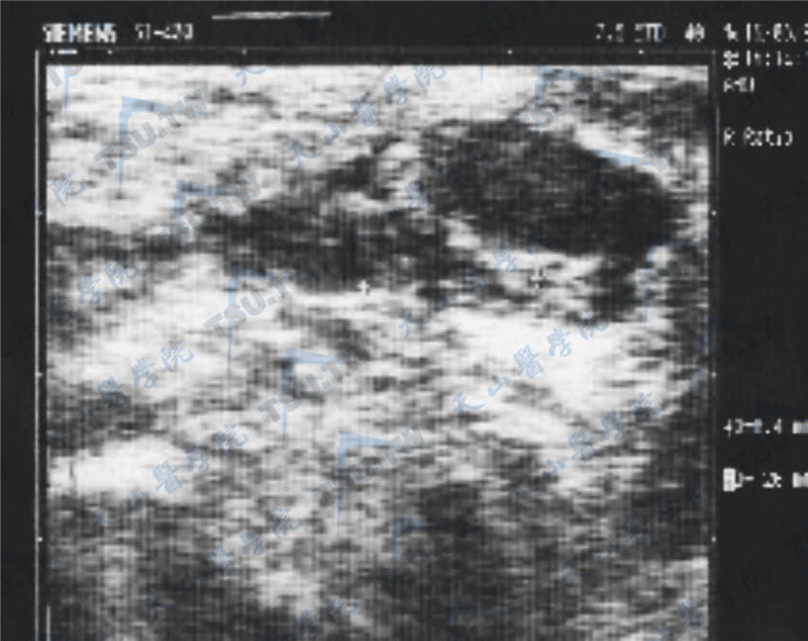 腹股沟型隐睾超声检查图像