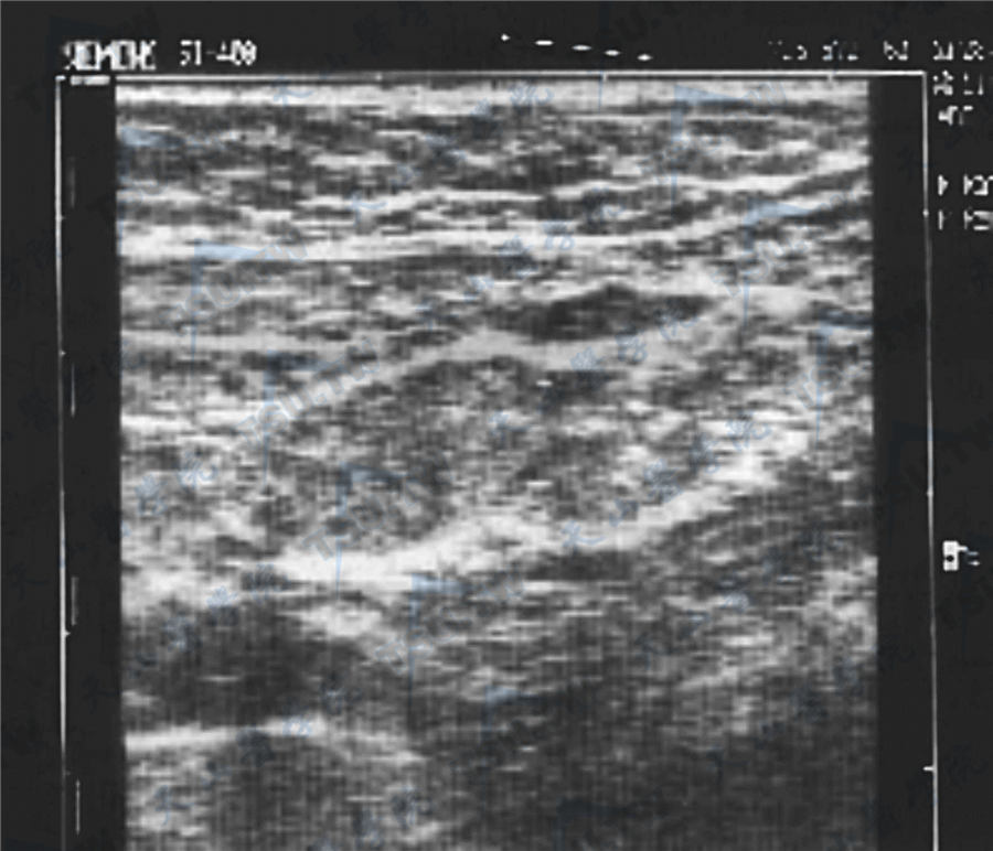 腹腔型隐睾超声检查图像