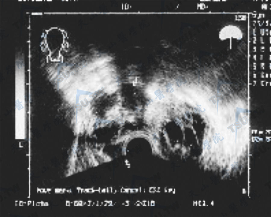 超声检查：多囊卵巢综合征伴多个囊泡状无回声液性暗区