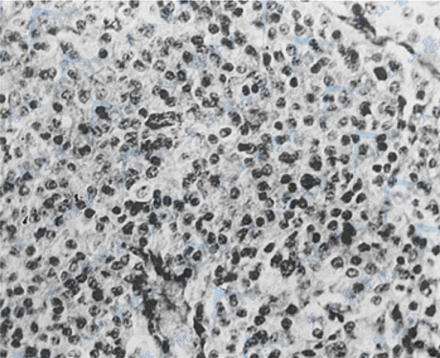 图1　垂体嫌色细胞腺瘤