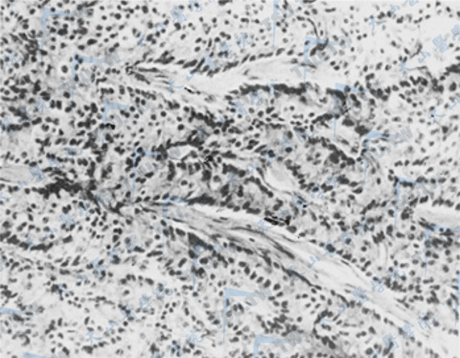 胰岛细胞瘤，注：瘤细胞呈梁索状和带状排列