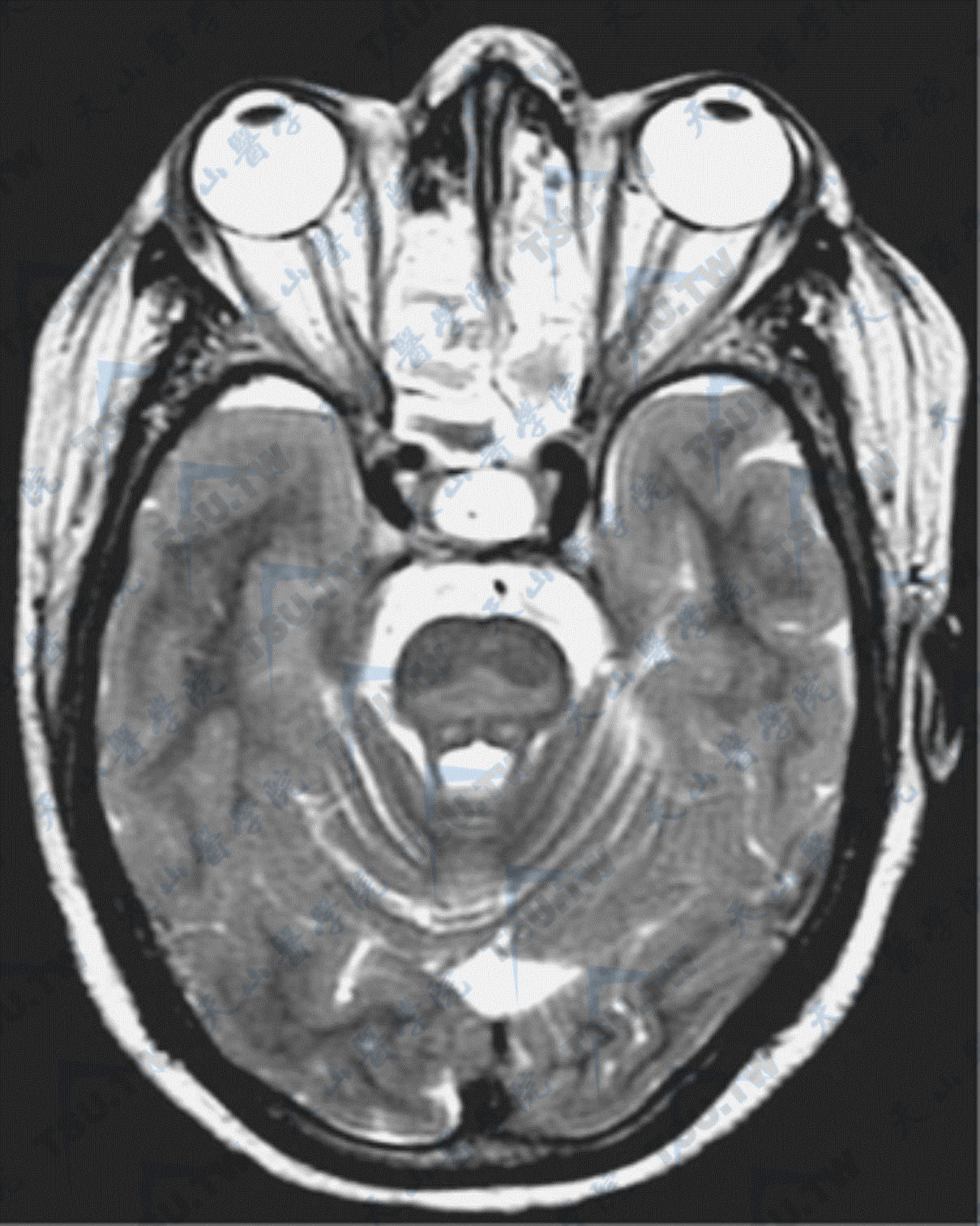渗透性脱髓鞘综合征的MRI所见