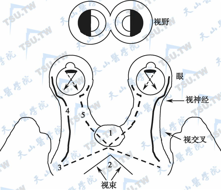 患垂体瘤的症状表现