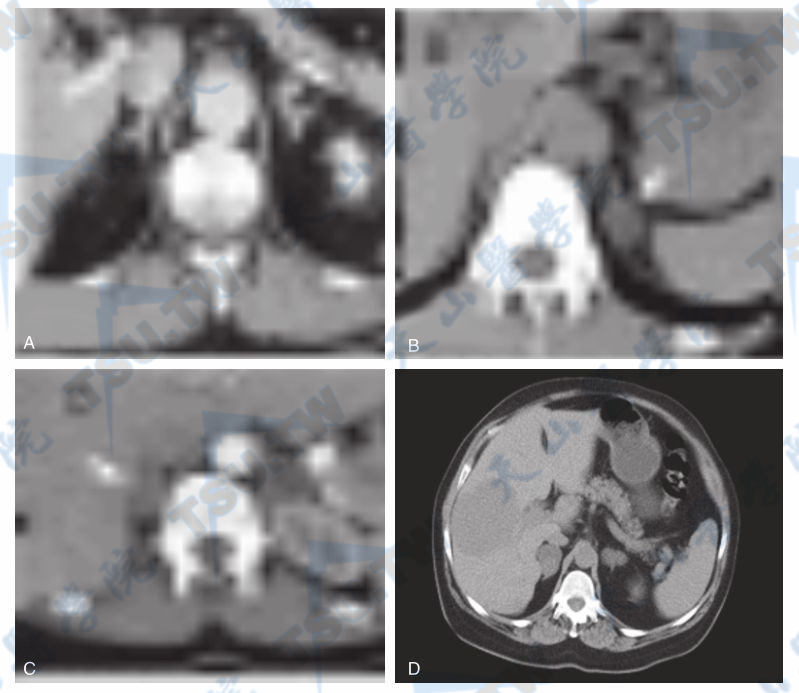  原醛症和肾上腺大结节性增生的CT诊断
