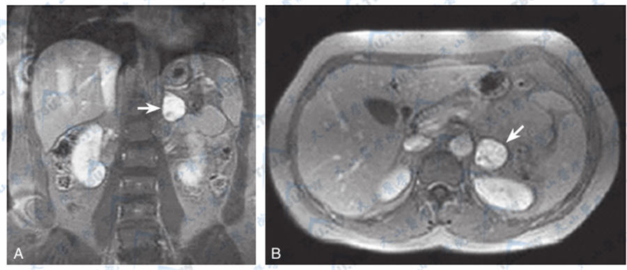  肾上腺嗜铬细胞瘤（MRI）