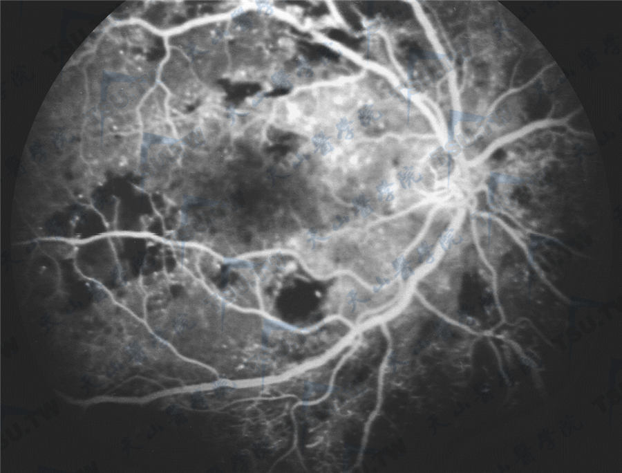 眼底荧光造影；注：微血管瘤、无灌注区及可疑新生血管芽