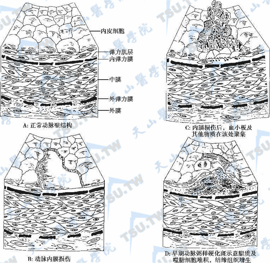  动脉粥样硬化斑的形成过程