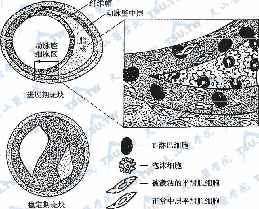  脆性斑块和动脉硬化性血栓的形成