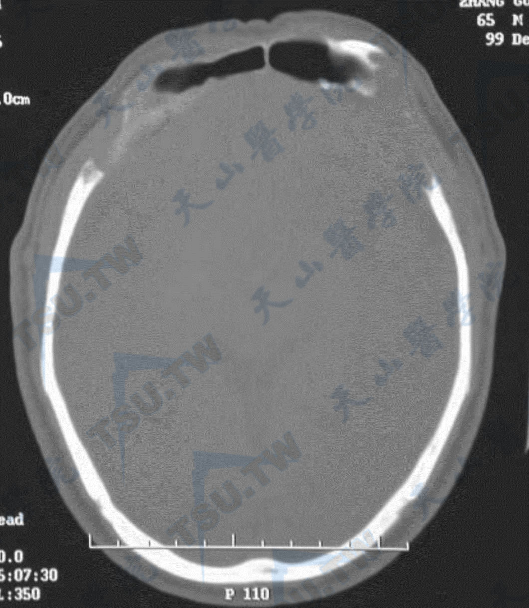 大块骨溶解症