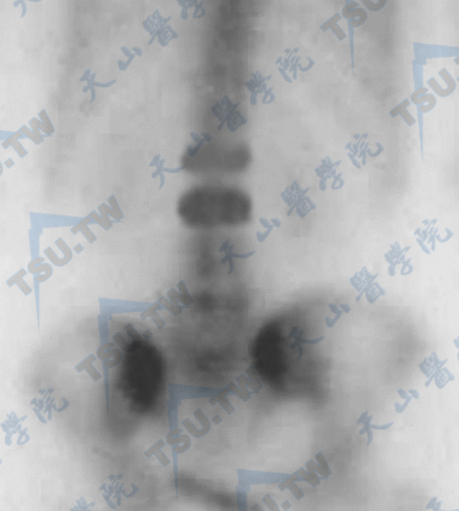  骨质疏松新旧压缩骨折