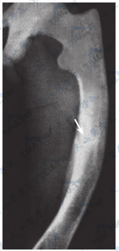  软骨病的假骨折线