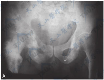 Paget骨病（骨盆正位X线片与骨显像）