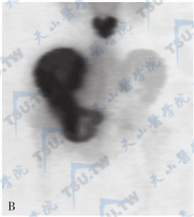 Paget骨病(骨盆正位X线片与骨显像)