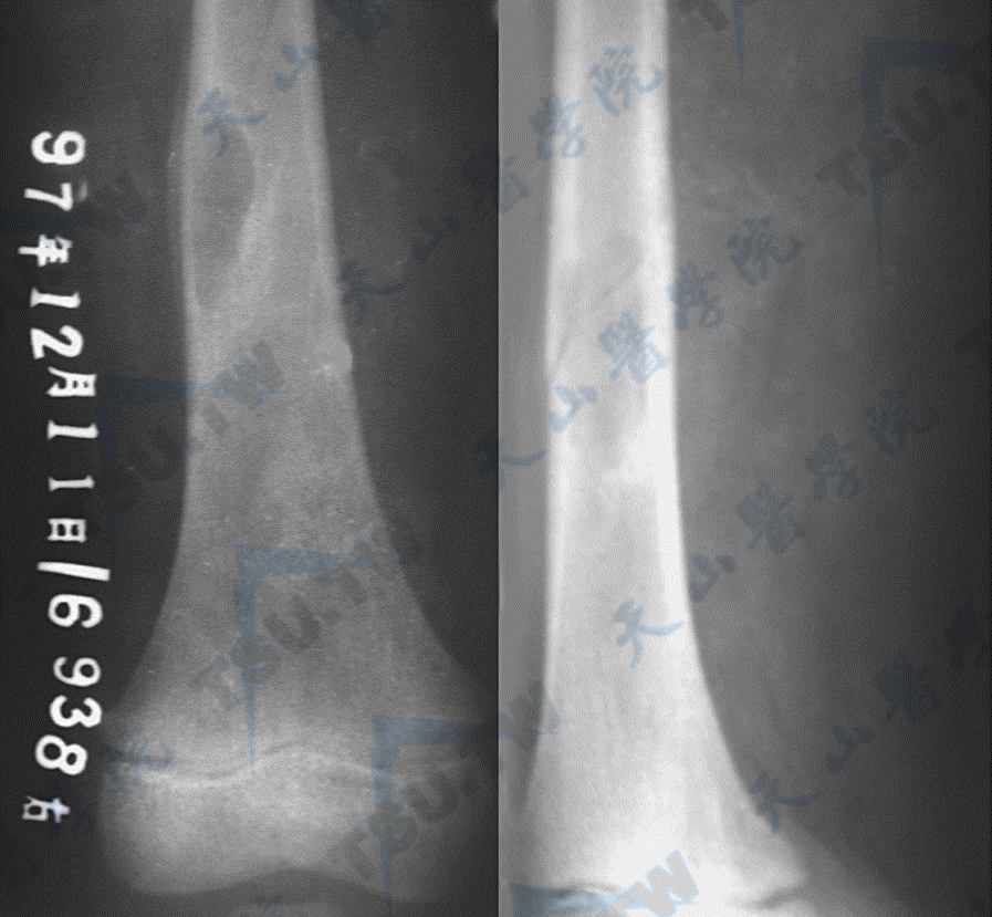 Albright综合征的骨纤维结构不良（MRI）